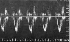 What PW Doppler signal is this?