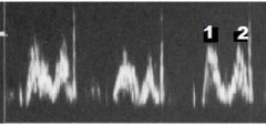 What PW Doppler signal is this? Label numbers 1 & 2