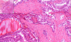 Thyroid gland
- Ground glass nuclei - with deep intranuclear grooves
- True papilles seen (with fibrovascular stroma - like in papilloma)
- Small calcifications --> Psammomatous bodies

Etiology?
Risk factors?
Radio-imaging?
Diagnosis?
Pr...