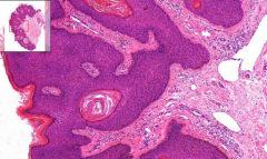 Some exophytic skin growth

- Hyperplasia of dermis:
o Acanthosis
o Papillomatosis
o Hyperkeratosis
o Parakeratosis

- Horny globules (or horny balls as Prof. Steiner said…) trapped in hyperplastic epidermis
- Hyperpigmentation of epide...