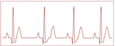 Patient is on the cardiac unit following admission for CHF and history of an MI. The patient is currently compensated by pharmacological management and is comfortable, alert and oriented at rest with normal HR and BP. The telemetric ECG to depicts...