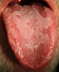 - benign migratory glossitis
- irregular, smooth red patches on parts of tongue
- desquamation of filiform papillae 
1-2% of population 