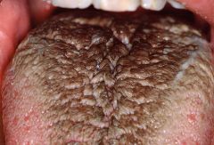 - hyperplasia of filiform papillae
- ineffective desquamation of papillae
- bacterial pigment