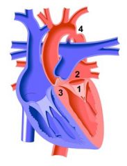 Shone syndrome is characterised by four congenital heart defects, largely multiple left sided obstructions:  

supravalvular mitral membrane (SVMM) 
subaortic stenosis (membranous or muscular)
parachute mitral valve
coarctation of the aorta