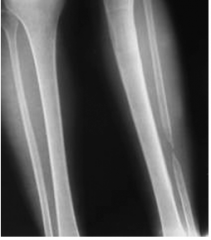 A PT is working with a client who fracture of the left fibula three months ago. The client is still having pain with exercise. Based on the recent radiograph pictured and the given information, the prognosis for this client is:


A – 176