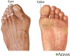 i. flat or slightly elevated, circumscribed, painful lesions with a smooth, hard surface
 1. soft corns-caused by the pressure of the bony prominence against softer tissue; these appear as whitish beginnings, commonly between the fourth and fifth toes
 