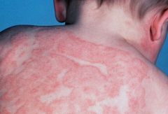 i. Definition
 1. most common inflammatory skin disorder; several forms, including irritant contact dermatitis, allergic contact dermatitis, atopic dermatitis
 ii. Pathophysiology
 1. common factor of the various forms is intracellular edema and epider