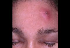 i. Definition
 1. a.k.a. Boil
 2. a deep-seated infection of the pilo sebaceous units
 ii. Pathophysiology
 1. Staphylococcus aureus most common organism
 2. initially, a small perifollicular abscess that spreads to the surrounding dermis and subcuta