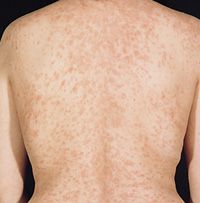 i. Pityriasis rosea: unknown cause, typical christmas tree distribution occurs on the chest. Lesions in parellal alignment that follow the ribs. 
ii. Definition
 1. self-limiting inflammation of unknown cause
 iii. Pathophysiology
 1. sudden onset wit