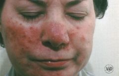 i. Rosacea: Chronic inflammatory skin disorder, usually seen on the middle of the face. Treat with topical antibiotics.
 ii. Definition
 1. chronic inflammatory skin disorder
 iii. Pathophysiology
 1. lasts over years, with episodes of activity follow