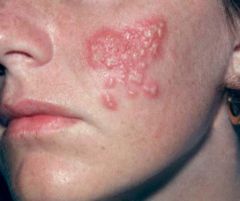 i. Definition
 1. infection by herpes simplex virus (HSV)
 ii. Pathophysiology
 1. two different virus types caused the infection: type I, usually associated with oral infection, and type II, with genital infection
 2. crossover infections are becomin