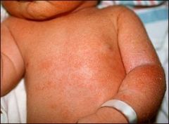 i. Miliaria: prickly heat
 ii. Pathophysiology
 1. caused by sweat retention from occlusion of sweat ducts during periods of heat and high humidity
 2. results from immaturity of skin structures
 3. overdressed babies are susceptible to this condition