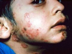 i. Definition
 1. comment, contagious superficial skin infection
 ii. Pathophysiology
 1. caused by staphylococcal infection and/or infection of the epidermis
 iii. Subjective Data
 1. lesion, typically on the face, that itches and burns
 iv. Object