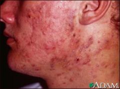 i. Pathophysiology
 1. androgens stimulate the Pilo sebaceous units at the time of puberty to enlarge and produce a large amount of sebum
 2. simultaneously, the keratinization process in the Pilo sebaceous canal is disrupted with impaction in obstructi