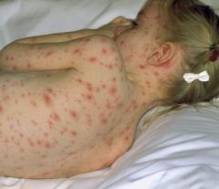 i. Chickenpox: Start on scalp and trunk and move outwards. Vessicles. Several stages of maturation. Contagious until scab over.
 ii. Definition
 1. acute, highly communicable disease common in children and young adults
 iii. Pathophysiology
 1. caused