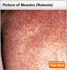 i. Measles: Start on face and neck and spread to trunk and extremities. Viral, prodome fever, conjuntvitis, bronchitis. Ends 4 days after the rash appears.
 ii. Definition
 1. also called hard measles or red measles
 iii. Pathophysiology
 1. measles v