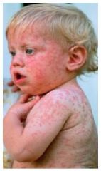 i. German measles: fine maculopapular eruption on the hariline that spreads rapidly cephlocaudally. Occipital or posterior cervical lymphadenopathy. During first trimester usually leads to birth defects.
 ii. Definition
 1. mild, febrile, highly communi