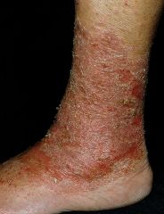 i. Stasis Dermatitis: from edema and related to peripheral vascular disease.
 ii. Pathophysiology
 1. occurs on the lower legs in some patients with venous insufficiency
 2. incompetent venous valves, inadequate tissue support, and postural hydrostatic