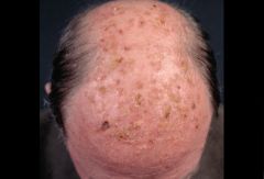 i. Solar Keatosis: secondary to chronic sun damage, has malignant potential.
 ii. Definition
 1. squamous cell carcinoma confined to the epidermis
 iii. Pathophysiology
 1. occurs secondary to chronic sun damage
 2. most lesions remain superficial; l
