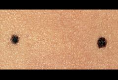i. features
 1. flat or slightly elevated; dark Brown
 ii. occurrence
 1. nevus cells lining dermoepidermal junction
 iii. comments
 1. should be removed if exposed to repeated trauma