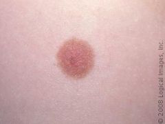 Breast round brown spot