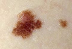 a. color
 i. mixture of tan, brown, black, and red/pink; moles on one person often do not look alike 
b. shape
 i. irregular borders may include notches; may fade into surrounding skin and include a flat portion level with skin
 c. surface
 i. may be