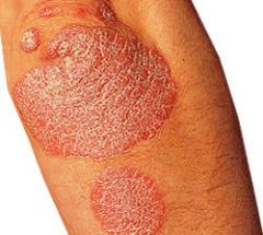 a. description
 b. Elevated, firm, rough lesion with flat top greater then 1cm
 c. example
 d. Psoriasis: inherited condition
 e. Seborrheic
 f. Actinic keratoses