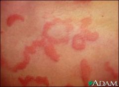a. description
 i. Elevated, irregular shaped area of cutaneous edema, solid
 ii. transient, variable diameter
 b. examples
 i. insect bites, urticaria, allergic reaction