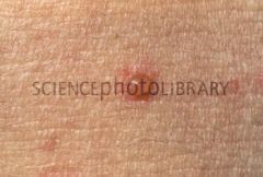 a. description 
i. Elevated, circumscribed superificial, not in dermis. Filled with serous fluid, less then 1cm
 b. Examples
 i. Varicella(chicken pox), herpes zoster (shingles)