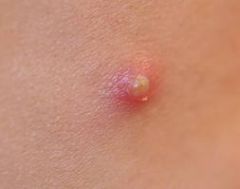 a. Description
 i. Elevated, superficial lesion similar to vesicle but filled with purulent fluid
 b. Examples
 i. impetigo, acne