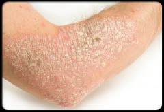 a. Description
 i. Heaped up, keratinized cells
 ii. Flaky skin, irregular, thick or thin, dry or oily
 iii. variation in size
 b. examples
 i. Dandruff: consider tinea capitus
 ii. Flaking of skin with seborrheic dermatitis following scarlet fever 