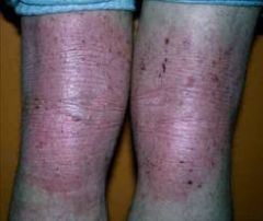 a. Description
 i. Rough, thickened epidermis. Usually related to persistent itching, rubbing and skin irritation.
 ii. often involves flexor surface of the extremity
 b. examples
 i. chronic dermatitis