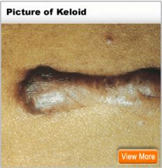 a. Description
 i. Irregular elevated, progressive enlarging scar. 
ii. Grows beyond the boundaries of the wound. 
iii. Caused by excessive collagen formation during the inflammatory stage of healing.
 b. Examples
 i. keloid formation following surge