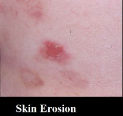 a. Description
 i. Loss of part of the epidermis, follows ruptures of blisters or vesicles
 ii. depressed, moist, glistening
 b. example
 i. varicella, variola after rupture