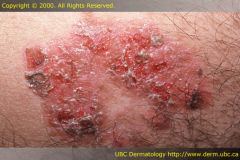 a. Description
 i. Dried serum, blood or purulent exudate. Elevated
 ii. slightly elevated; size varies; Brown, red, black, tan, or straw-colored
 b. examples
 i. scab on abrasion, eczema