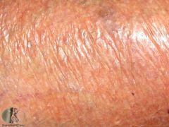 a. Description
 i. Thinning skin surface, loss of skin markings, paperlike, translucent
 b. example 
i. striae 
ii. aged skin