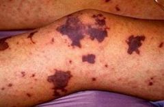 a. Red-purple nonblanchable discoloration greater then 0.5cm
 b. Intravascular defects, infection.