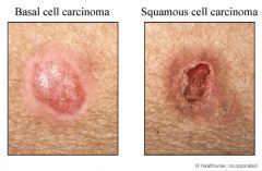 i. BasaL Cell: most common malignant neoplasm, commonly on the face. Fair haired people and sun exposure risk factors. Varies in presentation
 ii. Definition
 1. the most common form of skin cancer
 iii. pathophysiology
 1. cancer arises in the basal 