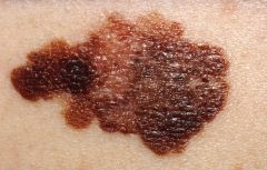 i. Melanoma: develops from melanocyte cells, migrate into the skin and other structures during fetal development. Cause is unknown, herediatry and sun exposure are risk factors. Suspect if any change in a nevus.
 ii. Definition
 1. lethal form of skin c