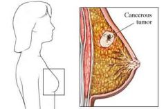  Definition
  ductal carcinoma arises from the epithelial lining of ducts; lobular carcinoma originates in the glandular tissue of the lobules
  pathophysiology
  mutations in normal cells result in uncontrolled cell division and tumor formation; a
