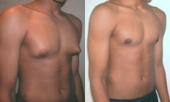  Definition
  breast enlargement in men
  pathophysiology
  result in increased body fat; hormone imbalance from puberty or aging; by testicular, pituitary, or hormone-secreting tumors; bio liver failure; or by a variety of medications including an