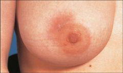  Definition
  inflammation and infection of the breast tissue
  pathophysiology
  most infections are staphylococcal, often Staphylococcus aureus
  most common in lactating women after milk is established, usually the second the third week after 