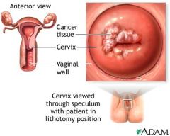  Definition
  classified according to the type of tissue from which the cancer arises squamous cell carcinoma and the adenocarcinoma; there are a few other rare types of cervical cancer
  Pathophysiology
  typically originates from the dysplastic o