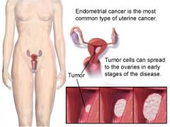 Pathophysiology
  occurs most often in postmenopausal women
  nearly all endometrial cancers are cancers of the glandular cells found in the lining of the uterus; most known risk factors for endometrial cancer are linked to the balance between estro
