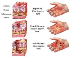 ii.	Partial Thickness (2nd)
1.	Moist, blisters, painful
2.	MOST PAINFUL