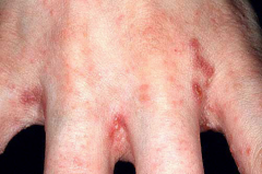 Often first noticed in hands where there are rashes and tracks of red linear papules.  

Seen in web spaces between fingers, knees, elbows, penis, beltline, scapula

Itching is worse at night (classic sign)

Symptoms may appear 4-6 weeks after expos