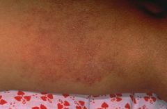 Papular eczematous dermatitis with redness and scaling, vesicular lesions.
Rx: Cutaneous hydration, Glucocoticoids possible,  Avoidance of irritants