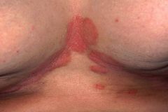 Red moist glistening plaques extend to just beyond the limits of opposing skin folds. Advancing border is sharply defined – with ‘satellite lesions’
Rx: Nystatin powder, Ketoconazole cream.