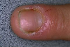 Superficial infection of the skin around the nail at the cuticle and nail bed. Localized redness and swelling 
Rx: Soaks, Incision and Drainae (I&D)
– if mild, treat with topical e.g. bacitracin topical 500u/g tid
If moderate, add oral Dicloxacillin, C