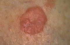 Ranges from in situ to metastatic.  Similar to lesions such as actinic keratosis
Smooth, dull red, firm, dome shaped, sharply defined nodule with a potentially crusted center – can be from mouth, plantar feet.
Rx: Surgical excision, radiation.